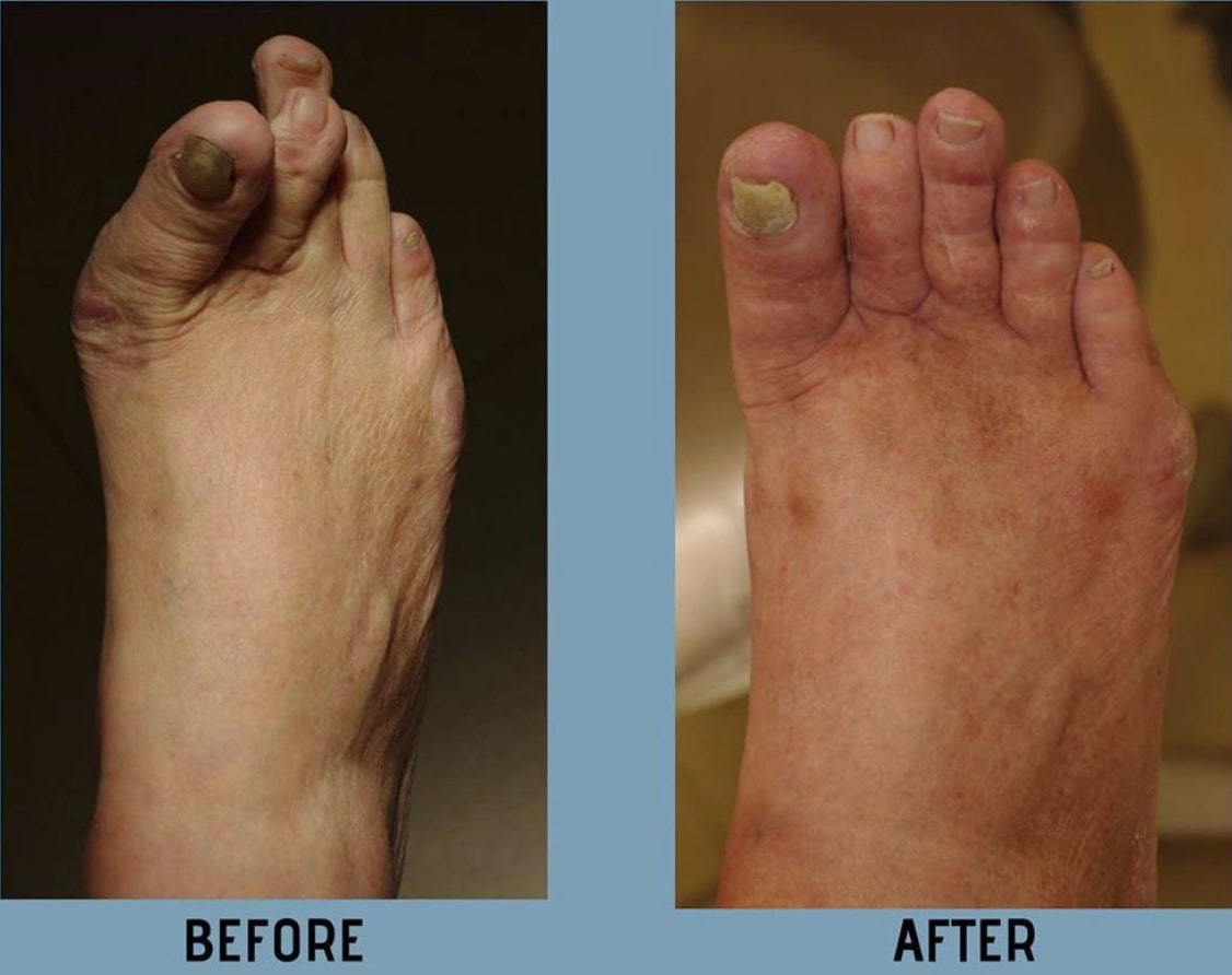 Cosmetic Foot Surgery Before And After Corrective Foot Surgery New York